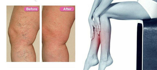 Varicose Vein Skin care lotion